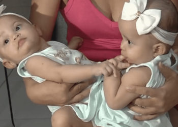 Cirurgia de gêmeas siamesas da Bahia, no HMI, é prevista para agosto