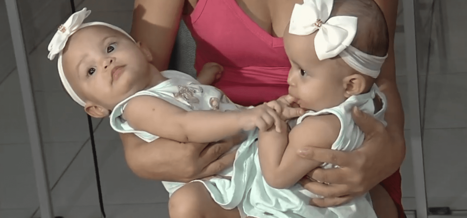 Cirurgia de gêmeas siamesas da Bahia, no HMI, é prevista para agosto