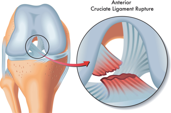 Diferencia entre tendones y ligamentos