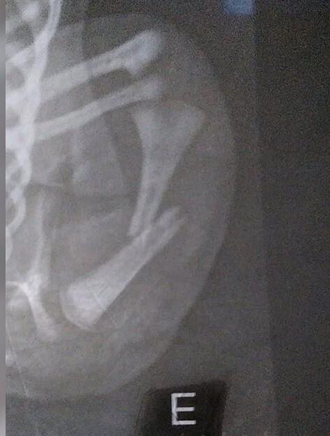Bebê tem braço quebrado durante parto em hospital de Aparecida de Goiânia