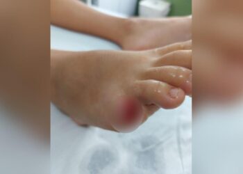 Criança tem dedo arrancado por piranha em lago de Buriti Alegre