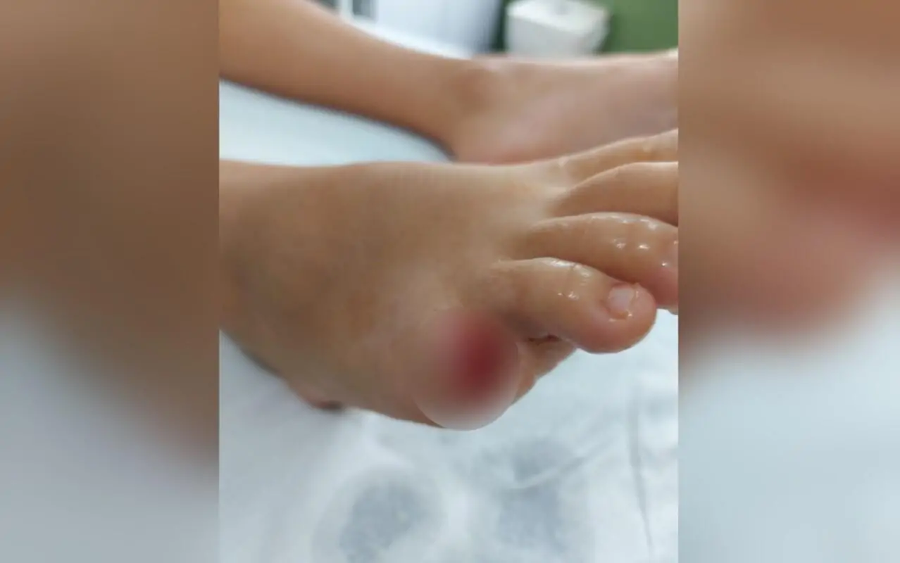 Criança tem dedo arrancado por piranha em lago de Buriti Alegre