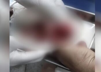 Homem perde parte do dedo após ataque de piranhas em lago de Buriti Alegre