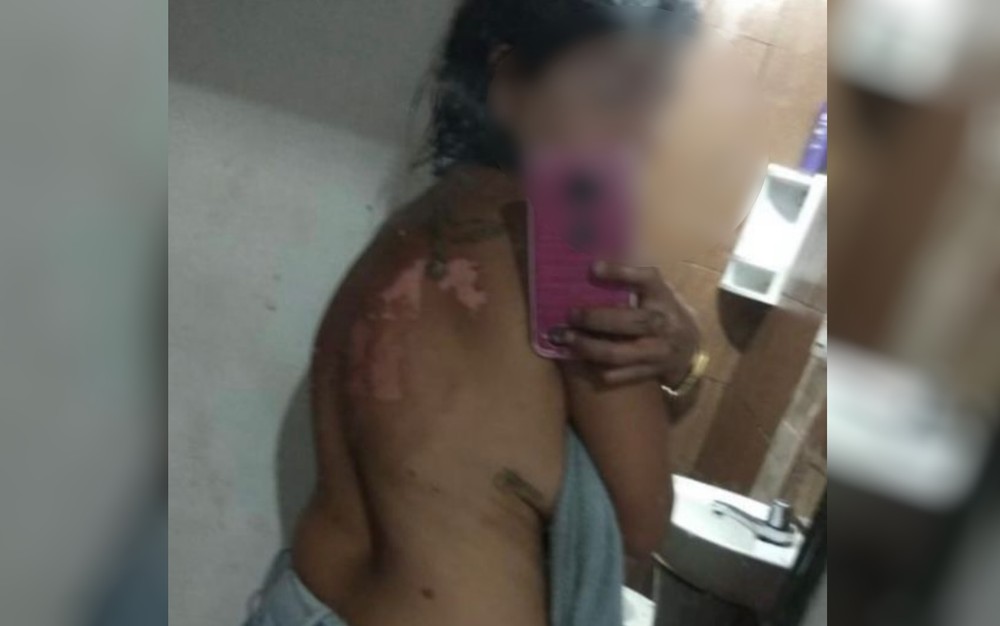 Mulher tem corpo queimado com óleo quente após briga por ciúmes, em Santa Helena 