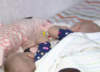 Gêmeas siamesas passam por nova cirurgia preparatória para separação em Goiânia