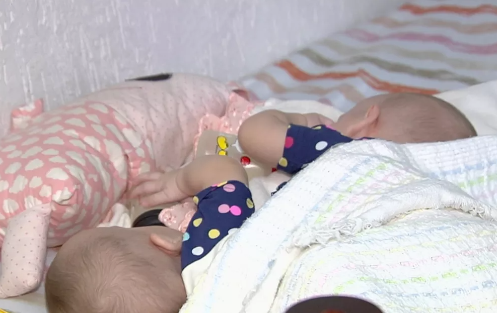 Gêmeas siamesas passam por nova cirurgia preparatória para separação em Goiânia