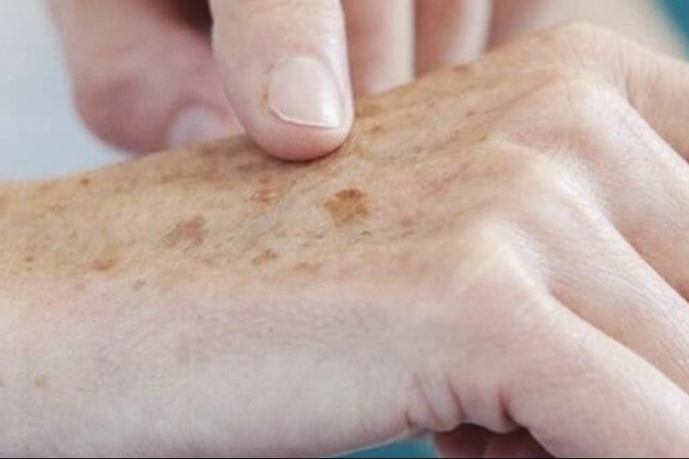 Dezembro laranja: Goiás oferece consultas e exames contra câncer de pele