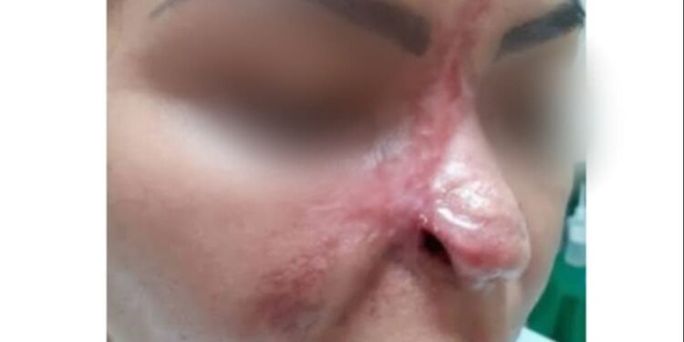 Dentista é indiciado após mulher perder parte do nariz em cirurgia estética, em Aparecida