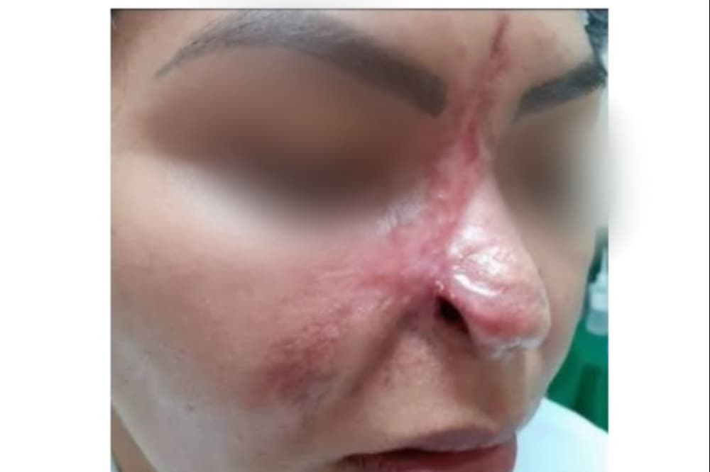 Mulher perde parte do nariz após cirurgia estética: “É assustador