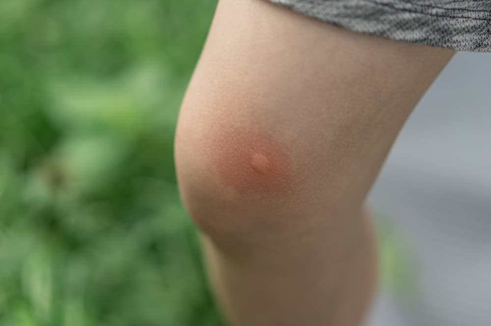 Malária é transmitida através da picada de mosquito