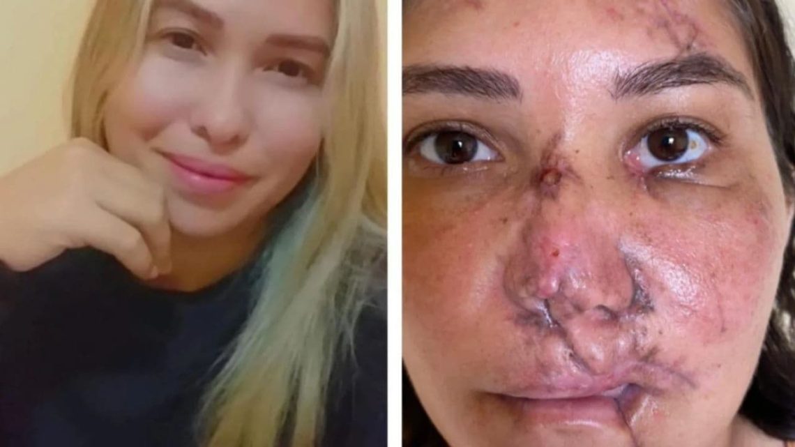 Mulher ganha cirurgia plastica de medico goiano apos ter rosto desfigurado em acidente 1