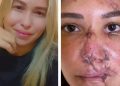 Mulher ganha cirurgia plástica de medico goiano após ter rosto desfigurado em acidente