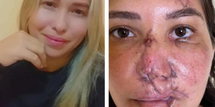 Mulher ganha cirurgia plástica de medico goiano após ter rosto desfigurado em acidente