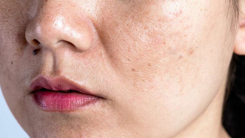 Conheça os 5 melhores especialistas em melasma no Brasil