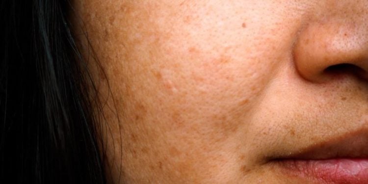 Conheça os 5 melhores especialistas em melasma no Brasil