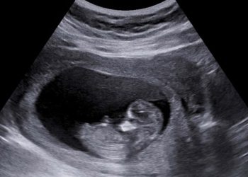 Lei de Goiás contra o aborto exige que grávida ouça o coração do feto