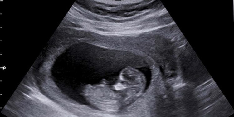 Lei de Goiás contra o aborto exige que grávida ouça o coração do feto