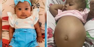 Bebê de 4 meses com suspeita de tumor na barriga luta por tratamento no SUS, em Goiás