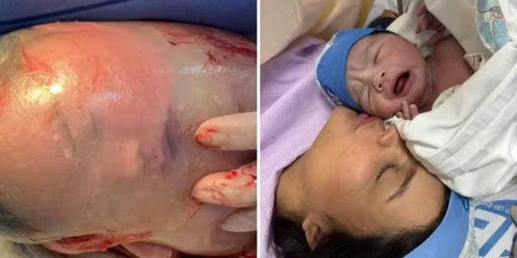 Confira o momento em que bebê nasce empelicado em hospital de Goiás