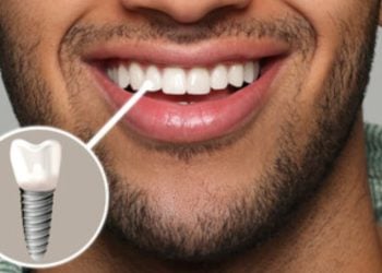 Como funcionam os implantes dentários e quais são seus benefícios