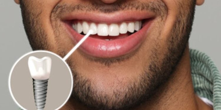 Como funcionam os implantes dentários e quais são seus benefícios