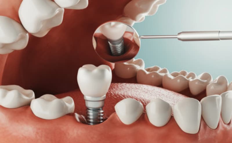 implante dentário