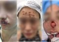 Influenciadores donos de clínica de estética são investigados por causar danos físicos em pacientes