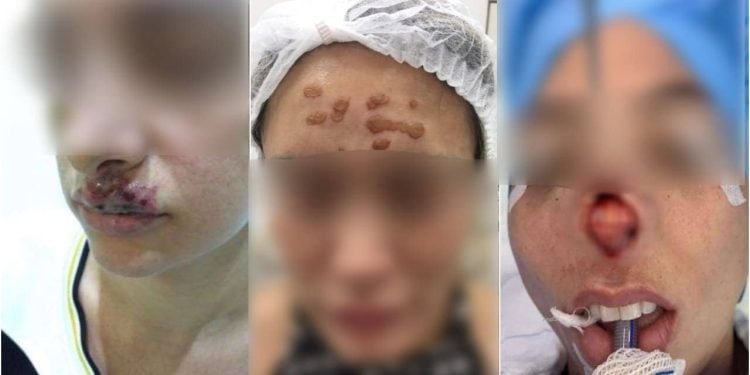 Influenciadores donos de clínica de estética são investigados por causar danos físicos em pacientes