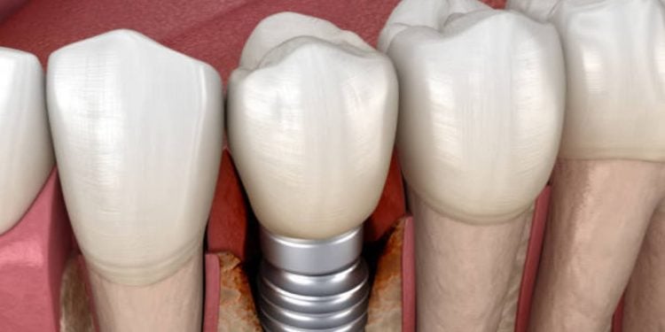 Como é feita a cirurgia de implante dentário em Belo Horizonte: um guia completo