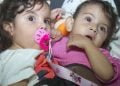 Hospital em Goiânia segue protocolo de morte encefálica de gêmea siamesa separada em cirurgia