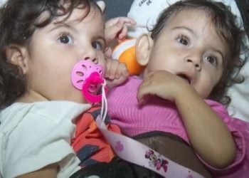Hospital em Goiânia segue protocolo de morte encefálica de gêmea siamesa separada em cirurgia