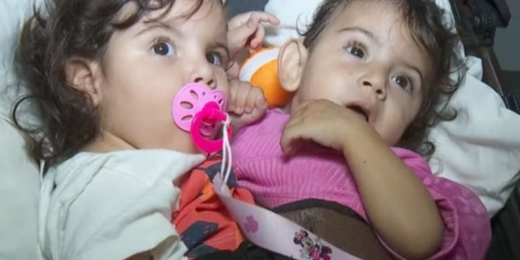 Hospital em Goiânia segue protocolo de morte encefálica de gêmea siamesa separada em cirurgia