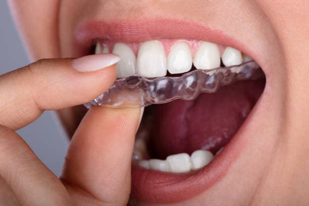 Tratamento ortodôntico em BH: conheça as opções de aparelhos e por que a Ortho 3D é referência no setor