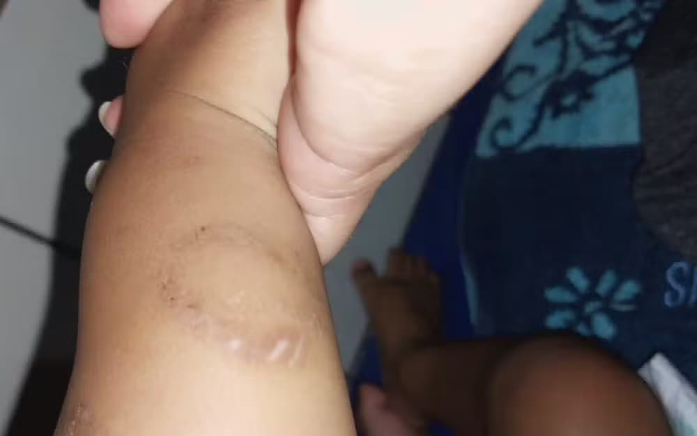 Marcas de mordida no bebê Gustavo Emanuel