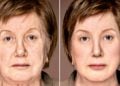 Lifting facial em Minas Gerais: preços, técnicas e os 3 melhores especialistas em BH