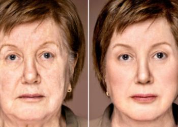Lifting facial em Minas Gerais: preços, técnicas e os 3 melhores especialistas em BH