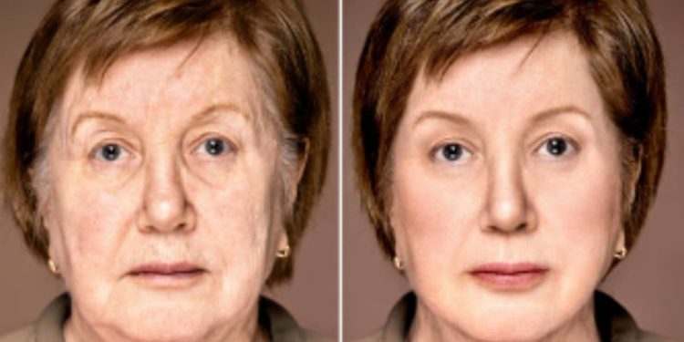 Lifting facial em Minas Gerais: preços, técnicas e os 3 melhores especialistas em BH