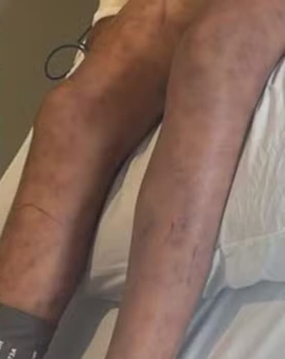 menino picado por abelhas