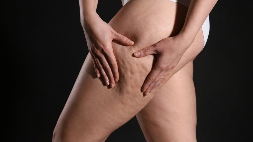 Lipedema