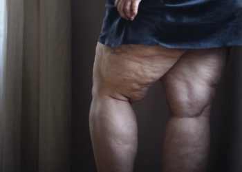 Câmara de Goiânia aprova política de atenção à saúde de mulheres com lipedema