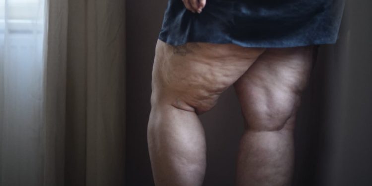 Câmara de Goiânia aprova política de atenção à saúde de mulheres com lipedema
